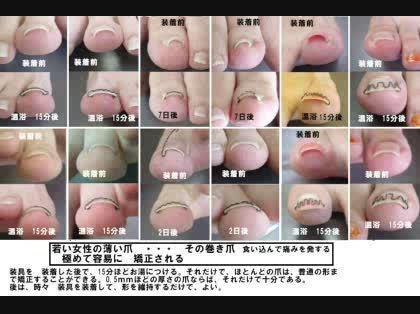 「巻き爪について」の回答画像6
