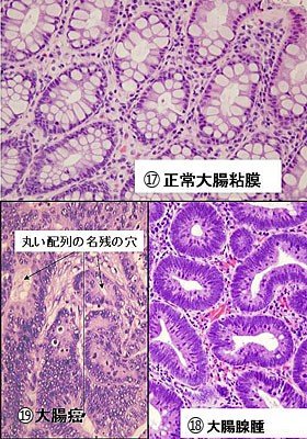 「前癌病変って何?」の回答画像5
