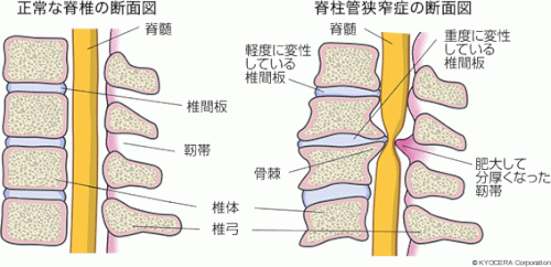 「腰部脊椎管狭窄症は治るのでしょうか?この」の回答画像4