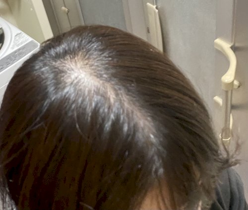 「抜け毛が酷くて悩んでます。25歳の女です」の質問画像