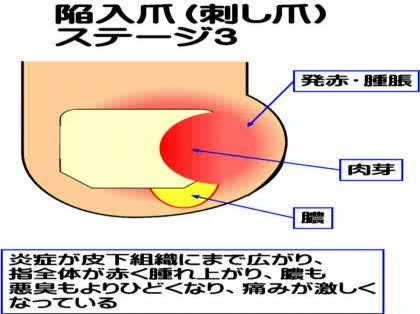 「陥入爪の自己治療について」の質問画像