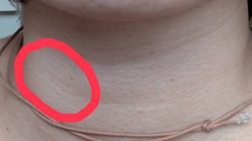 「悪性リンパ腫のしこりの特徴を教えてくださ」の質問画像