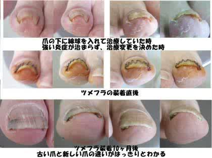「爪囲炎では爪を抜かないといけないですか?」の回答画像5