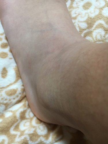 「腫れていると思いますか?? 6日前にバス」の質問画像