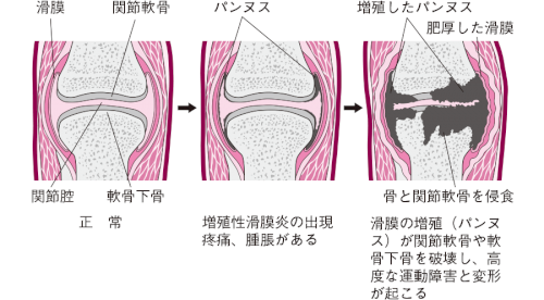 「母がリウマチで毎日薬を飲まないといけない」の回答画像3