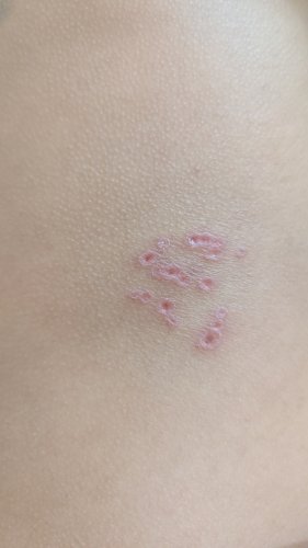 「この病気は何ですか?? 先ほど掻いてしま」の質問画像
