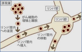 「リンパ行性転移について質問です。 リンパ」の回答画像1