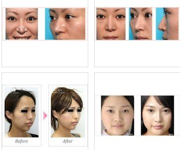 「美容整形についてです。 鼻の整形をするの」の回答画像2