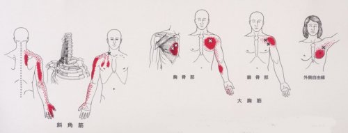 「頚椎症性脊髄症…について 手術する?しな」の回答画像1