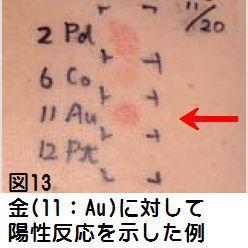 「純金と金属アレルギーの機序について」の回答画像4