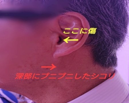 「首横のシコリについて参考程度に教えて下さ」の質問画像