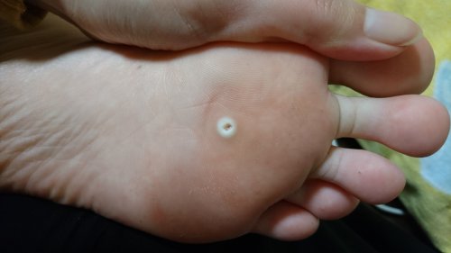 「魚の目でしょうか?(注意、足の裏の写真有」の質問画像