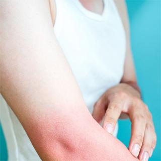皮膚科医に聞いた!日焼けをするとなぜ肌がかゆくなるのか?