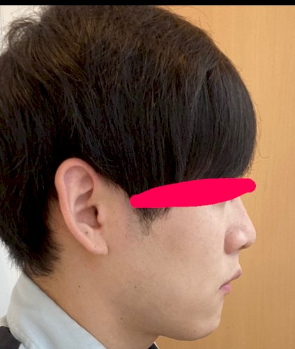 「矯正完治したのですがこれって口元下りすぎ」の質問画像
