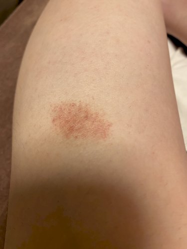 「アザが治らない、、2ヶ月以上このアザなん」の質問画像