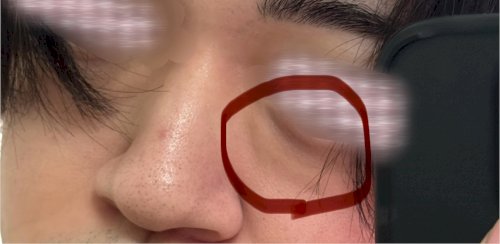「目の下に写真のような少し腫れ上がってるも」の質問画像
