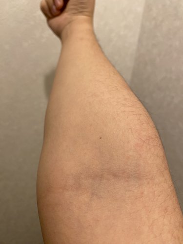 「ぼくの腕は採血しにくいですか？」の質問画像