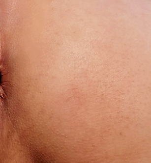 「肌がブツブツしているのが気になります。」の質問画像