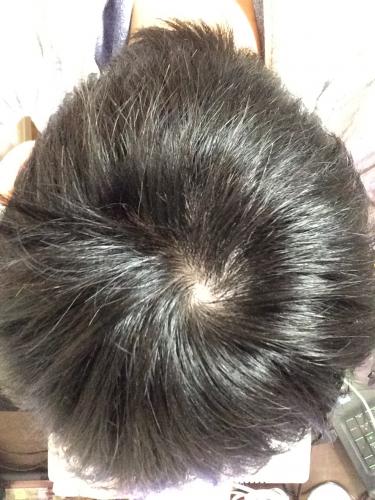 ハゲないか心配です つむじがハゲてないか心配ですこれは大丈夫でしょ 薄毛 抜け毛 教えて Goo
