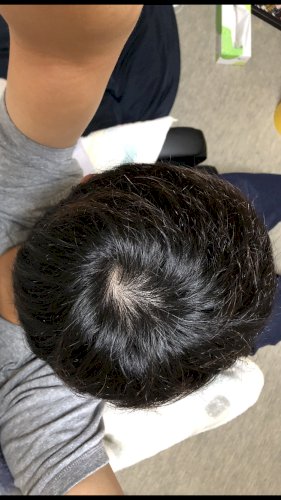 「つむじはげでしょうか？真剣に悩んでます」の質問画像