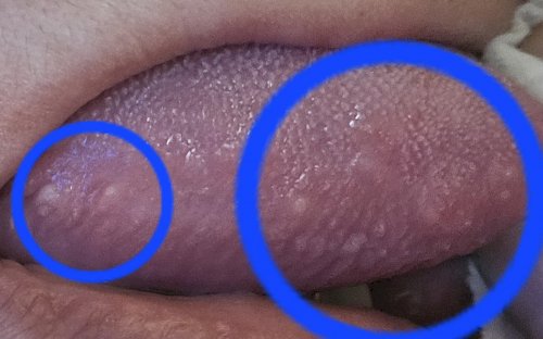 「白板症や舌癌についてわかる方お願いします」の補足画像2