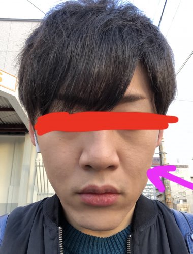 26歳です 顔の左右が全然違います 右半分の皮膚がたるんでおり 3年 皮膚の病気 アレルギー 教えて Goo 26歳です 顔の左右が全然違います 右半分の皮膚がたるんでおり 3年 皮膚の病気 アレルギー 教えて Goo