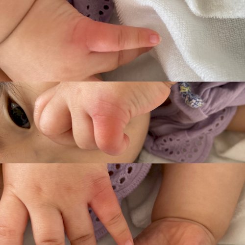 「１歳２ヶ月小指の付け根が真っ赤になって腫」の質問画像