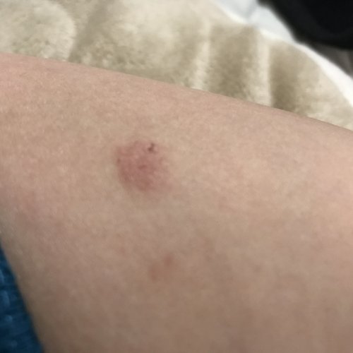 梅毒 バラ湿疹 痒みがない、色々なところにできる とみたのです