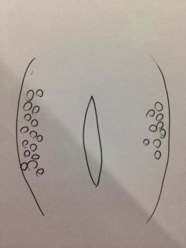 注 イラスト付 大陰唇 赤いブツブツが痛い お恥ずかしい質問ですが 婦人科の病気 生理 教えて Goo