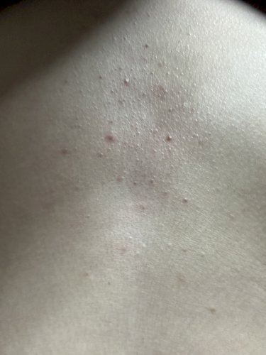 「胸前に赤くブツブツと白いブツブツが出てき」の質問画像
