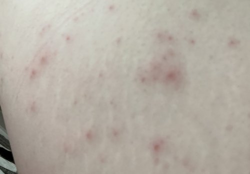 「左の腰辺りからお尻にかけてこのような発疹」の質問画像