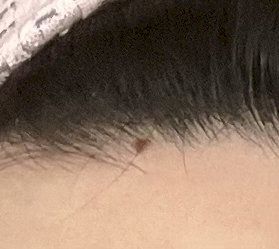 「前髪の生え際にホクロができてしまい、レー」の補足画像1