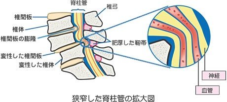 「梨状筋症候群、腰椎ヘルニア、脊柱菅狭窄、」の回答画像1