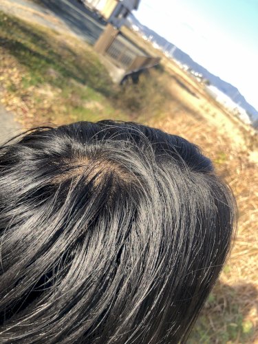 「このつむじハゲはどれくらい進行しています」の質問画像