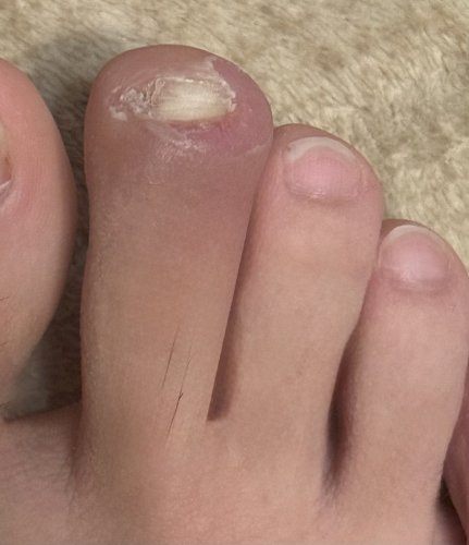 「足の指についての質問です。※写真が少し汚」の質問画像