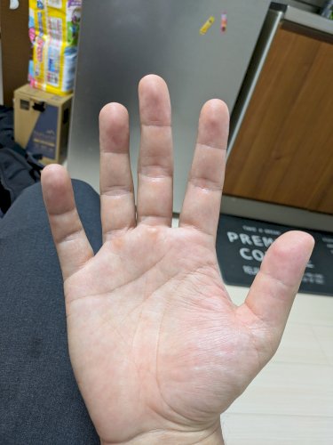 「これは手掌紅斑ですか？」の質問画像