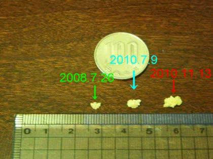 「尿路結石が出たものの…。」の質問画像