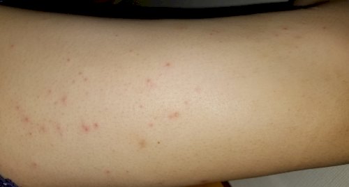 身体のかゆみ 閲覧注意ここ2週間前くらいから全身にかゆみを感じてい 皮膚の病気 アレルギー 教えて Goo
