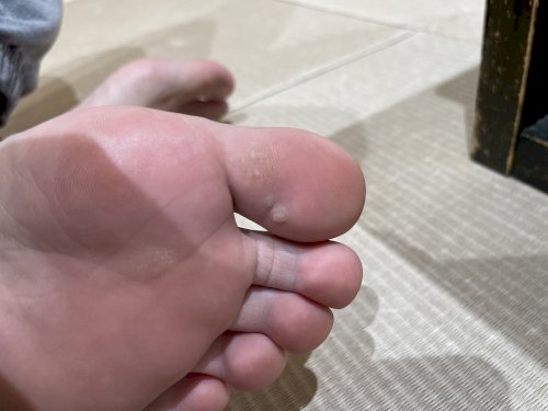 「足の裏に白いブツブツができています。 こ」の質問画像