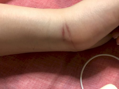 「なんか気づかないうちに手首のところが こ」の質問画像