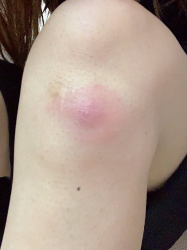 「一昨日くらいにひざをつくと痛みがあり、蚊」の質問画像