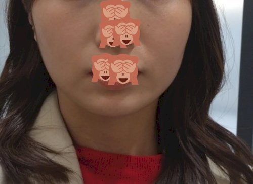 「このたるみは表情筋トレーニングで改善でき」の質問画像