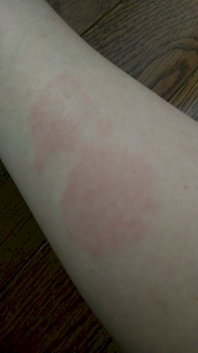 「これ湿疹？虫さされ？ 朝気づいたら、腕の」の質問画像