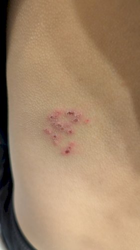 「この病気は何ですか？？ 先ほど掻いてしま」の補足画像1
