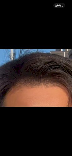 「太陽を向くと生え際が透ける 写真は太陽を」の質問画像