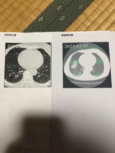 「肺がんについて」の質問画像