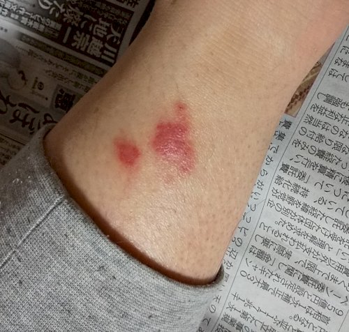 「何の虫さされか教えてください」の質問画像