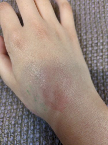 「【少し閲覧注意です。⠀】昨日から変な虫刺」の質問画像