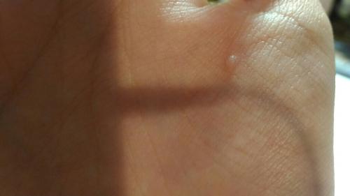 続けての質問すみません、 これは水いぼでしょうか？ -続けての質問す 