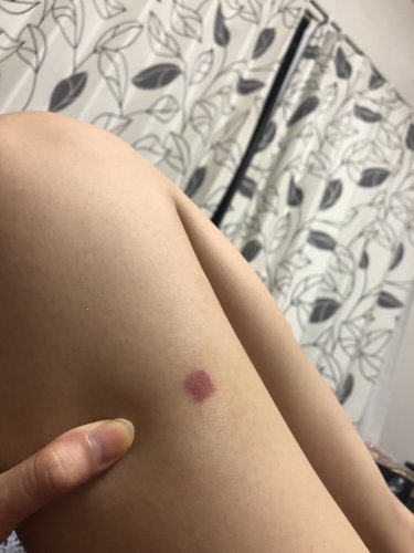 「これなんの虫刺されだと思いますか、、 一」の質問画像